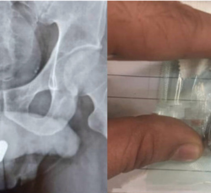 Uomo finisce all’ospedale con una pila infilata nel pene: “L’ha tenuta per 24 ore. Cicatrici gravi all’uretra”