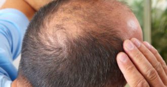 Copertina di Calvizie, i rimedi naturali per la caduta dei capelli: sfatiamo il mito degli integratori. Il ruolo chiave dell’alimentazione