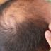 Copertina di “Prima era solo un sospetto, ora c’è la conferma. Ozempic, Wegovy e i farmaci dimagranti aumentano la perdita dei capelli, soprattutto negli uomini già predisposti all’alopecia”: il nuovo studio