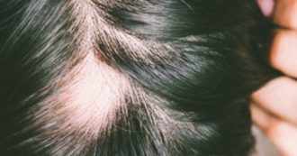 Copertina di Alopecia, la forma di cui soffre Jada Pinkett Smith “è associata a una malattia autoimmune”: ecco di cosa si tratta