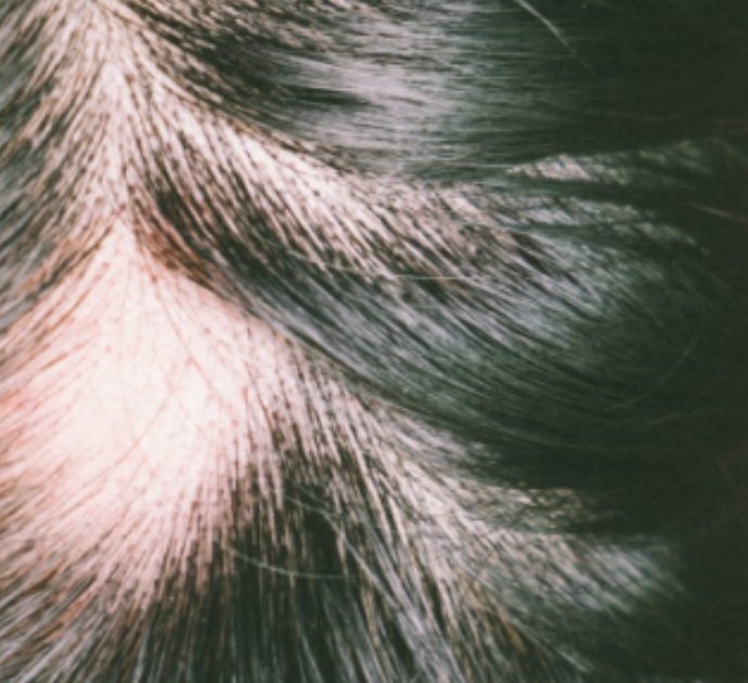 Alopecia, la forma di cui soffre Jada Pinkett Smith “è associata a una malattia autoimmune”: ecco di cosa si tratta