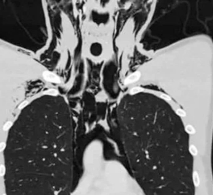 “Pneumomediastino spontaneo con enfisema dopo essersi masturbato”: il caso di un 20enne sulla rivista scientifica Radiology Case Reports