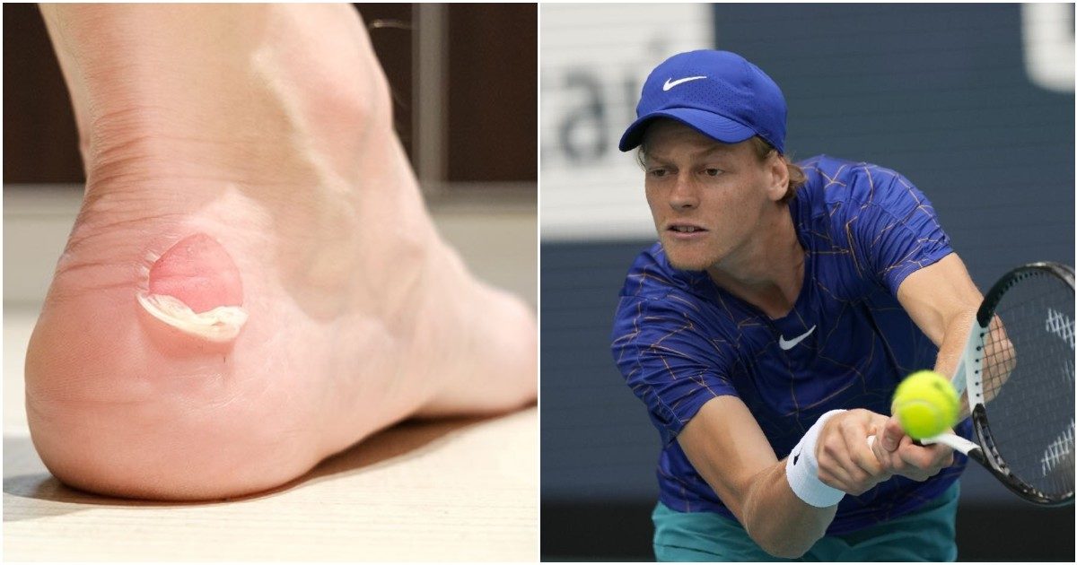 Jannik Sinner, il campione di tennis assillato dalle vesciche ai piedi: “Ecco cosa non bisogna assolutamente fare per toglierle”. Parla l’esperto