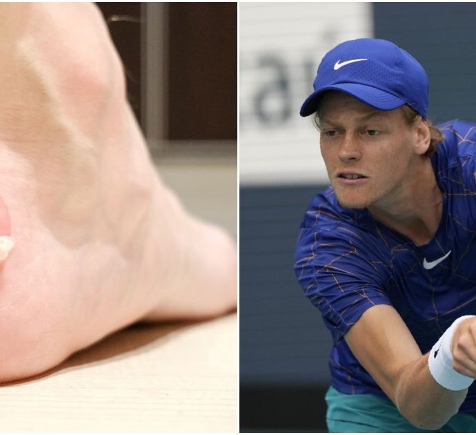 Jannik Sinner, il campione di tennis assillato dalle vesciche ai piedi: “Ecco cosa non bisogna assolutamente fare per toglierle”. Parla l’esperto