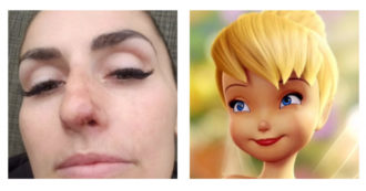 “Iniettarsi filler sulla punta del naso per assomigliare a Campanellino di Peter Pan”: la ‘moda estetica’ che preoccupa i medici. I rischi? Dalla necrosi alla cecità