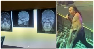 Copertina di Piero Pelù cade dal palco e sbatte testa e schiena contro un gradino durante il concerto a Milano: poi pubblica le lastre e spiega come sta – VIDEO