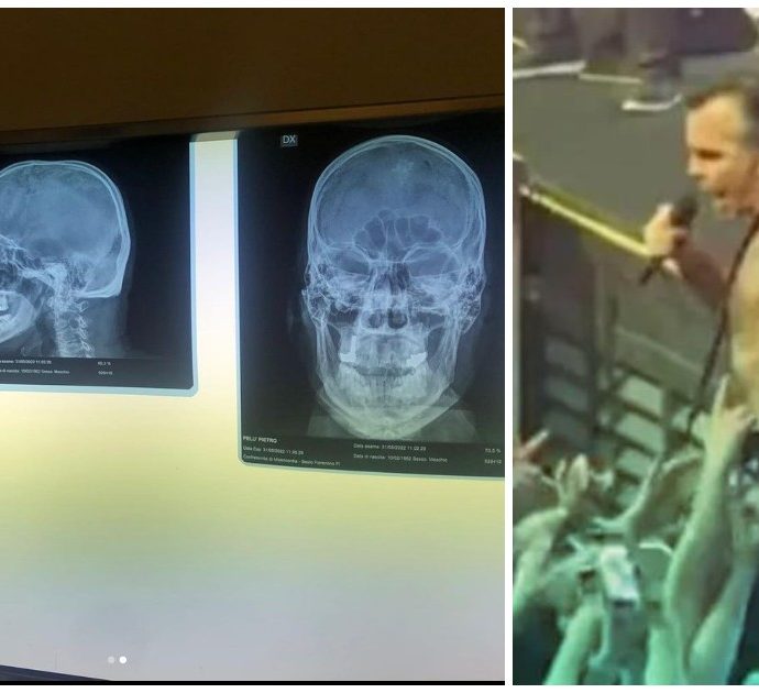 Piero Pelù cade dal palco e sbatte testa e schiena contro un gradino durante il concerto a Milano: poi pubblica le lastre e spiega come sta – VIDEO