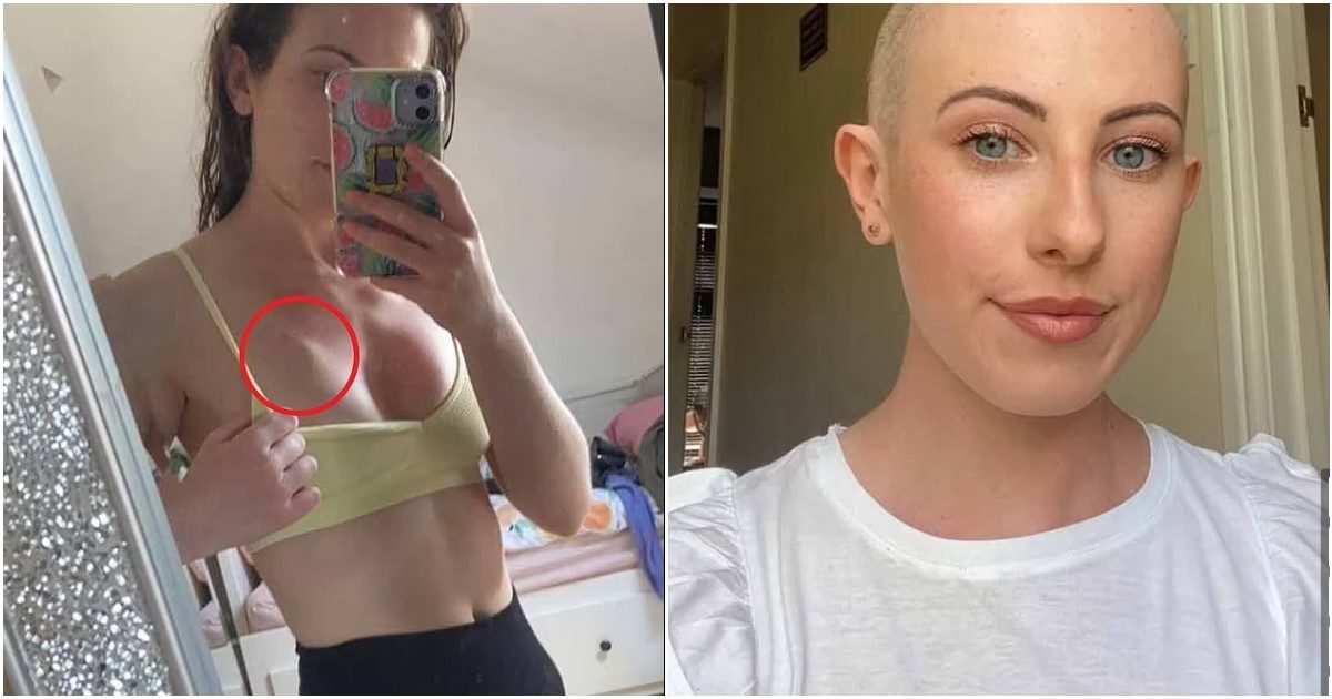 Tenta di schiacciare un brufolo sul petto: ragazza di 23 anni scopre che è un cancro al seno al 2° stadio
