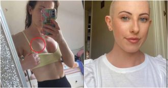 Copertina di Tenta di schiacciare un brufolo sul petto: ragazza di 23 anni scopre che è un cancro al seno al 2° stadio