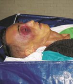 Copertina di “Un albanese in piazzale Clodio”, poi fu abbandonato in ospedale