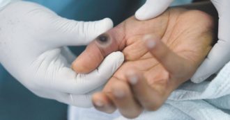 Copertina di Vaiolo delle scimmie,  studio: “In Italia il 95% dei casi tra uomini, l’età media è di 37 anni”