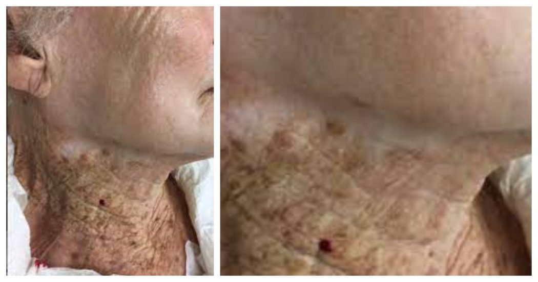 Mette la crema solare sul viso (ma non sul collo) per 40 anni, il dermatologo lancia l’allarme: “Ecco gli effetti sulla pelle”