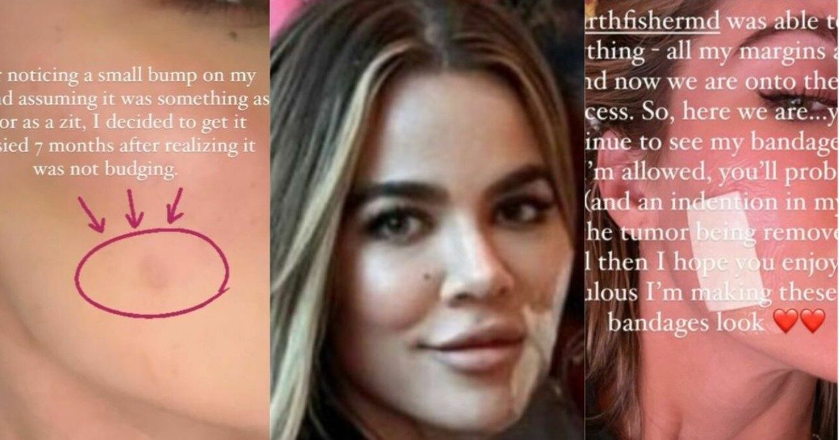 Khloé Kardashian e la scoperta di un tumore al viso: “Sembrava un brufolo, ma dopo 7 mesi non andava via”