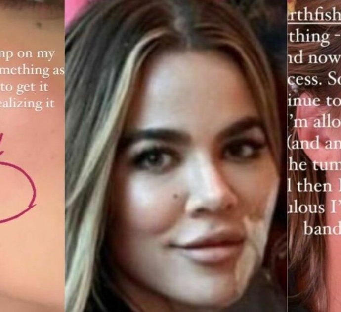 Khloé Kardashian e la scoperta di un tumore al viso: “Sembrava un brufolo, ma dopo 7 mesi non andava via”