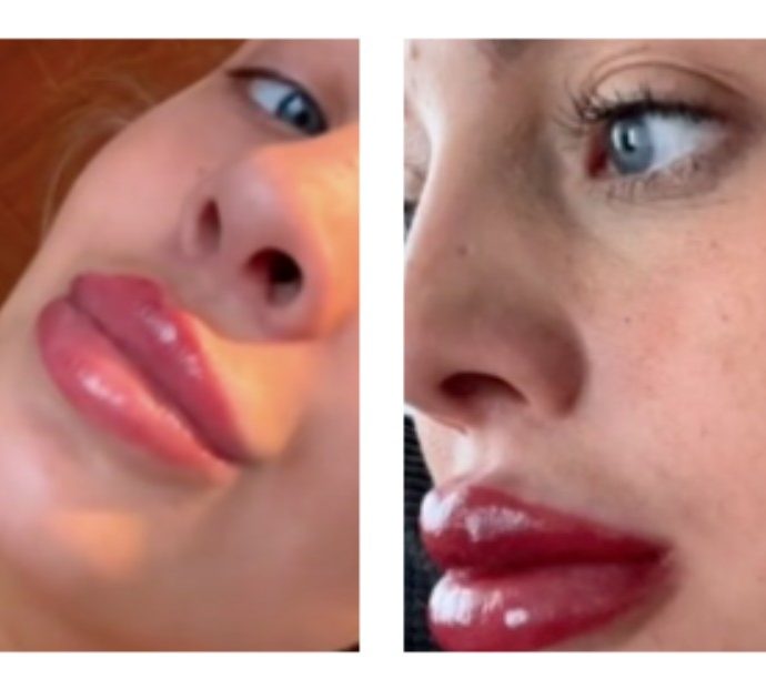 Si tatua le labbra ma il risultato è molto diverso da quello sperato: “Gonfie e deformi, sembrano il c*** di un babbuino”