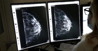 Copertina di Cancro al seno in fase precoce, “la terapia che riduce del 33% il rischio di malattia invasiva”. Lo studio in fase 3