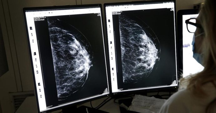 Cancro al seno in fase precoce, “la terapia che riduce del 33% il rischio di malattia invasiva”. Lo studio in fase 3