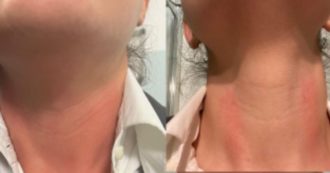 Copertina di Udine, 28enne guardia medica aggredita durante il turno: l’accompagnatore di un paziente ha cercato di strangolarla