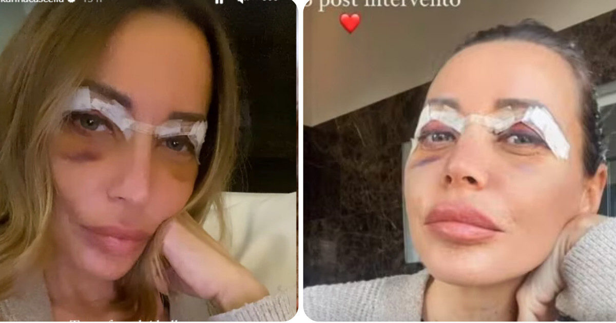 Karina Cascella, ematomi in volto e cerotti dopo l’operazione: “Non accettavo le mie palpebre da pesce lesso”