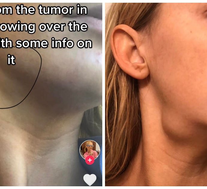 Helen Bender, la ragazza che ha scoperto di avere un tumore grazie a un trend di TikTok: “Pensavo fosse un linfonodo, poi si è ingrandito”