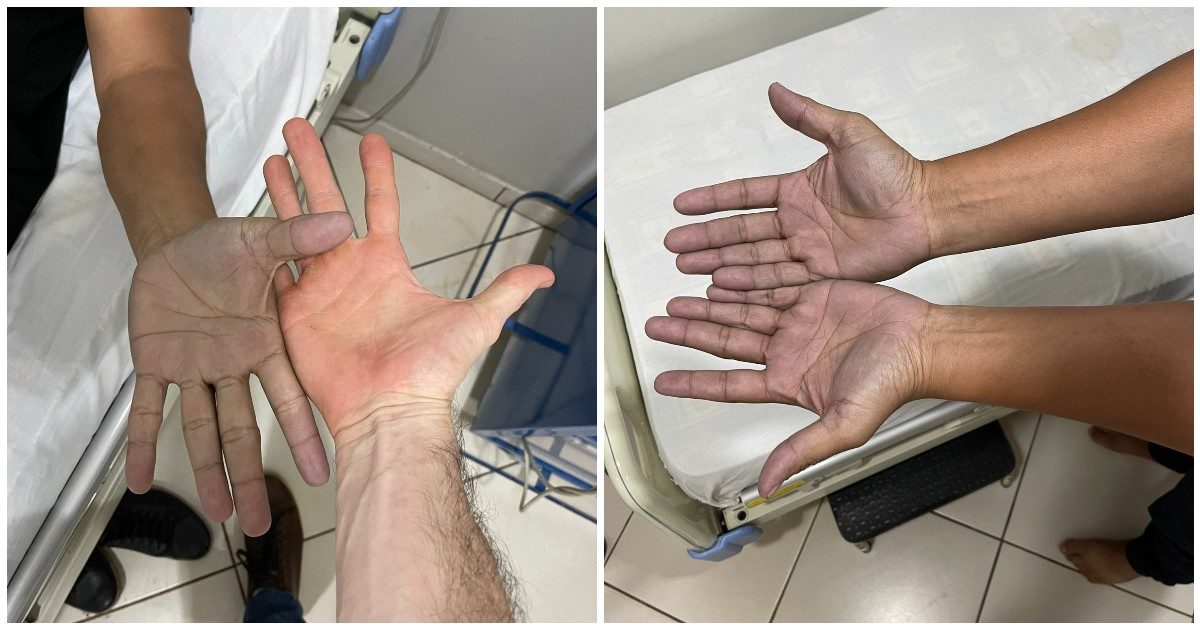Paziente si presenta al pronto soccorso con le mani blu, le ipotesi del medico: “Acrocianosi, malattia virale o trombosi da ipotrombinemia”. Poi la clamorosa scoperta