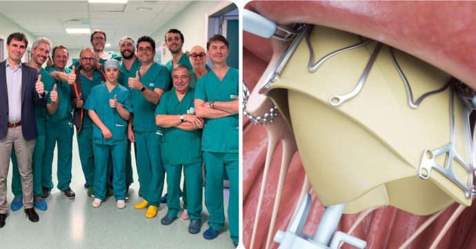 Impiantata per la prima volta al mondo una protesi in un cuore battente, il traguardo dell’ospedale Molinette