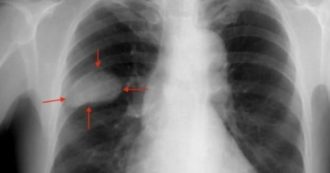 Copertina di Per 26 volte le diagnosticano il “mal di schiena”, poi si scopre che ha un cancro ai polmoni: donna muore a 56 anni, medici condannati a pagare risarcimento