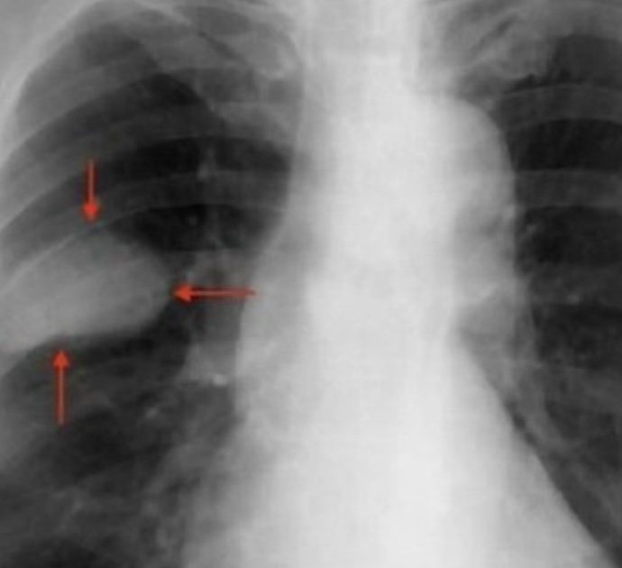 Per 26 volte le diagnosticano il “mal di schiena”, poi si scopre che ha un cancro ai polmoni: donna muore a 56 anni, medici condannati a pagare risarcimento