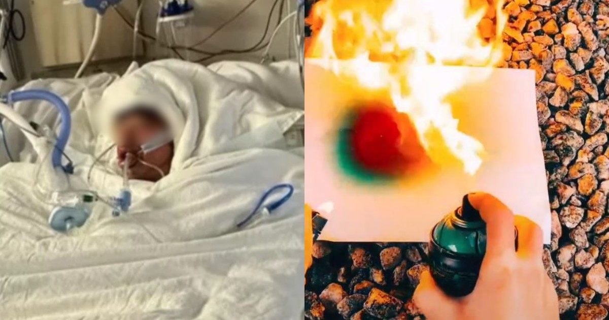 Fa la folle Firespray challenge di TikTok, ragazzo di 16 anni ricoverato in gravi condizioni: ha ustioni sul 75% del corpo. La madre: “È irriconoscibile”