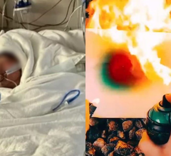 Fa la folle Firespray challenge di TikTok, ragazzo di 16 anni ricoverato in gravi condizioni: ha ustioni sul 75% del corpo. La madre: “È irriconoscibile”