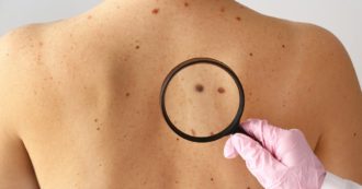 Copertina di Il melanoma da record, scoperto il cancro della pelle più piccolo al mondo: misurava 0,65 millimetri ed era quasi invisibile all’occhio umano