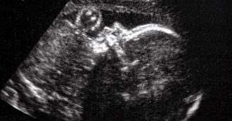 Copertina di Per la prima volta al mondo eseguito un intervento in utero su un feto su una vena nella cavità cranica
