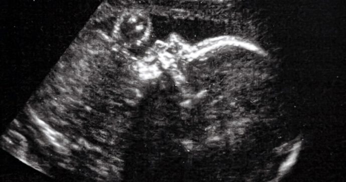 Per la prima volta al mondo eseguito un intervento in utero su un feto su una vena nella cavità cranica