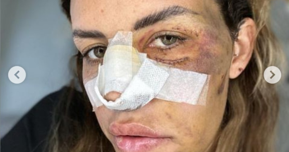 Carlotta Adacher pubblica le foto shock dell’incidente: “Tanta paura in quei secondi prima di chiudere gli occhi e non riuscire più ad aprirli”