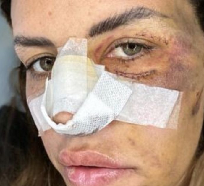 Carlotta Adacher pubblica le foto shock dell’incidente: “Tanta paura in quei secondi prima di chiudere gli occhi e non riuscire più ad aprirli”