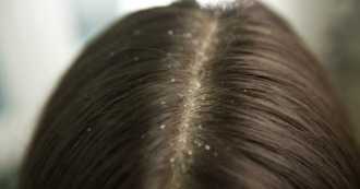 Copertina di Attenti agli shampoo, possono causare forfora e capelli grassi: ecco le tre sigle a cui prestare attenzione