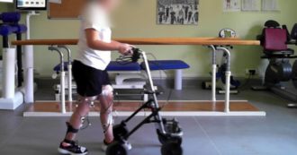 Copertina di Una 32enne paralizzata torna a camminare dopo 5 anni grazie a un neurostimolatore impiantato al San Raffaele