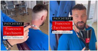 Copertina di Facchinetti: “Dopo 6mila bulbi e diecimila euro buttati, ho svoltato con i patch per i capelli”. E mostra i segni dell’inutile trapianto