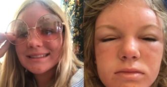 Copertina di “Mi sono addormentata cinque ore in spiaggia, l’indomani la mia faccia ha iniziato a gonfiarsi e avere vesciche. Era un’intossicazione solare”