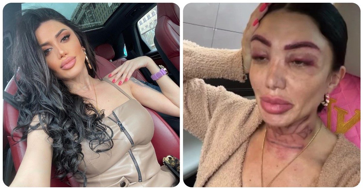 Influencer 33enne dopo alcuni ritocchi estetici: “La mia faccia è un palloncino, mi guardo e piango. L’ha fatto apposta”