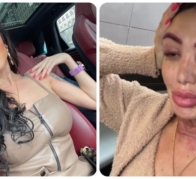 Influencer 33enne dopo alcuni ritocchi estetici: “La mia faccia è un palloncino, mi guardo e piango. L’ha fatto apposta”