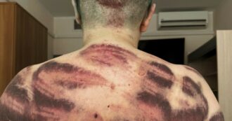 Copertina di Frustate alla schiena, dita rotte e testa rasata: le foto di Milashina, la giornalista russa aggredita. Per la Commissione “danni minori”