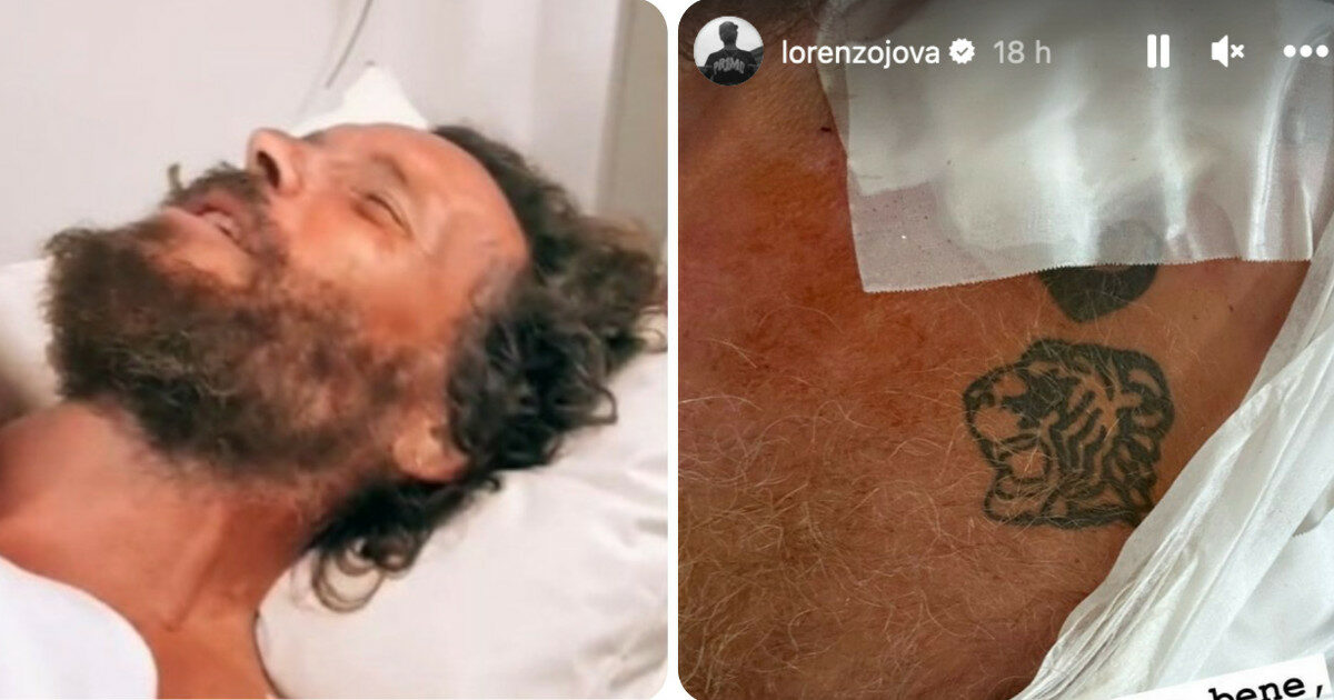 Jovanotti operato dopo l’incidente in bicicletta: “Dolore fortissimo”, ecco come sta