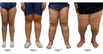 Copertina di Accumulo di grasso sulle gambe? Non è cellulite né colpa di un aumento di peso: è il lipedema. Ecco cos’è e come riconoscere questa patologia