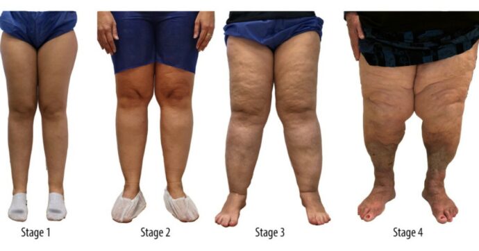 Accumulo di grasso sulle gambe? Non è cellulite né colpa di un aumento di peso: è il lipedema. Ecco cos’è e come riconoscere questa patologia