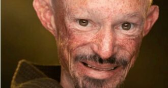 Copertina di Morto a 36 anni Darren Kent, l’attore de “Il trono di spade”: stroncato dall’osteoporosi, l’artrite e una rarissima malattia della pelle