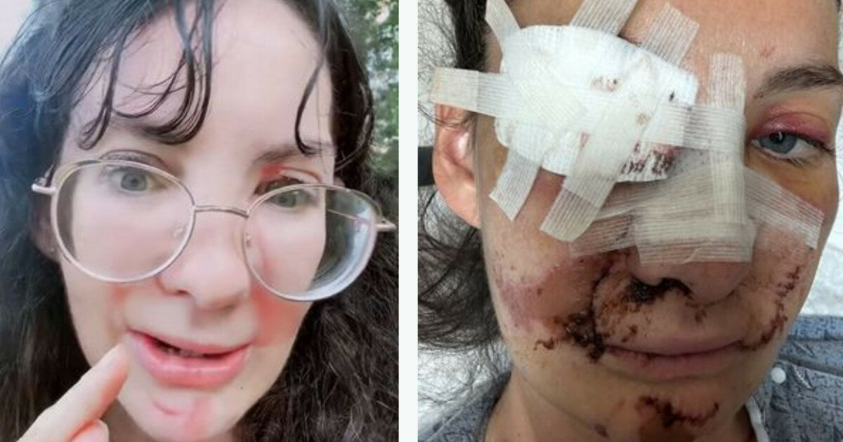 Travolta dalle balle di fieno mentre dà da mangiare ai cavalli si ritrova con il volto sfigurato: “Il naso mi è rimasto in mano”