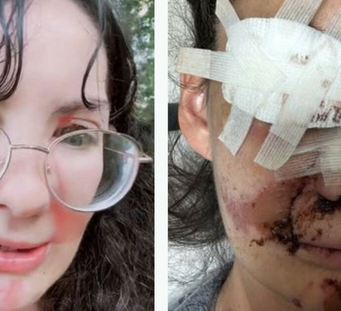 Travolta dalle balle di fieno mentre dà da mangiare ai cavalli si ritrova con il volto sfigurato: “Il naso mi è rimasto in mano”