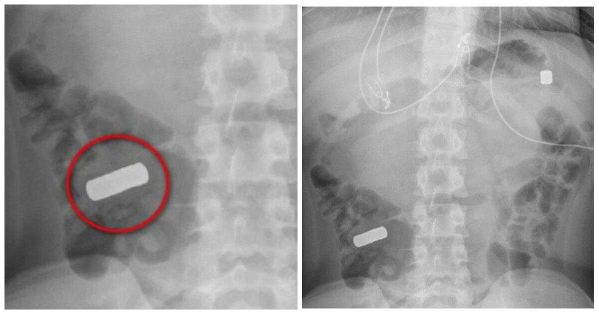 Adolescente arriva in pronto soccorso con dolori lancinanti all’addome, poi la scoperta choc dei medici: “Aveva ingerito 21 magneti e non se lo ricordava”