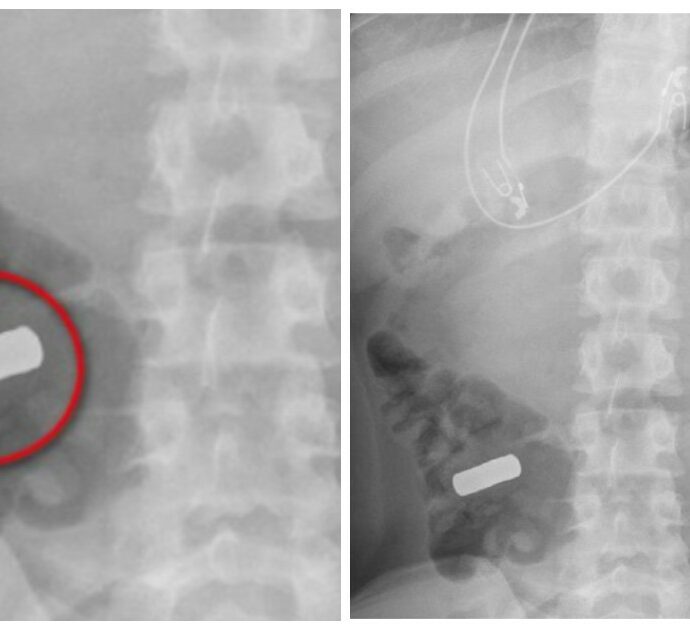 Adolescente arriva in pronto soccorso con dolori lancinanti all’addome, poi la scoperta choc dei medici: “Aveva ingerito 21 magneti e non se lo ricordava”